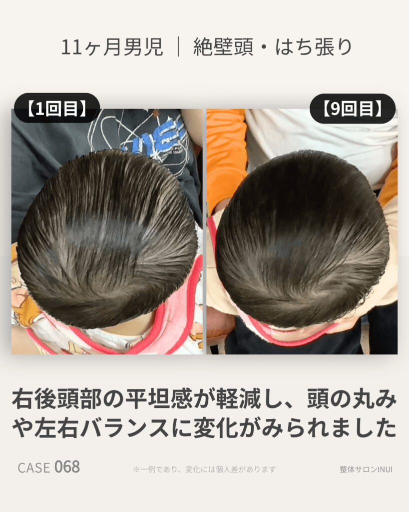 生後11ヶ月男児の絶壁頭ビフォーアフター比較