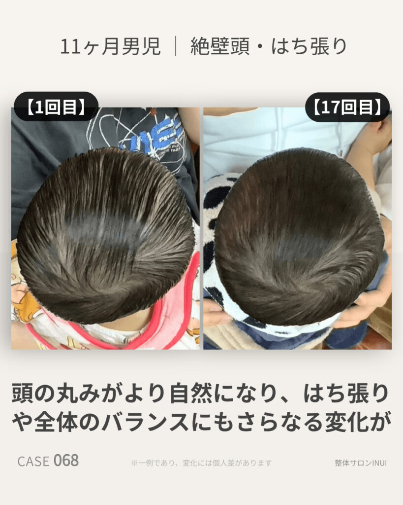 生後11ヶ月男児の絶壁頭ビフォーアフター比較