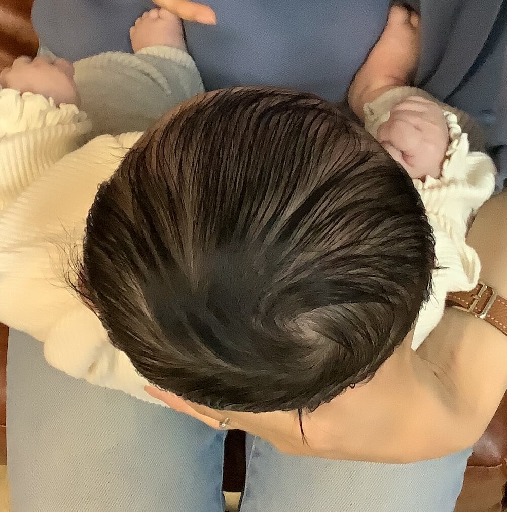 生後3ヶ月女児の絶壁頭による後頭部の平坦感