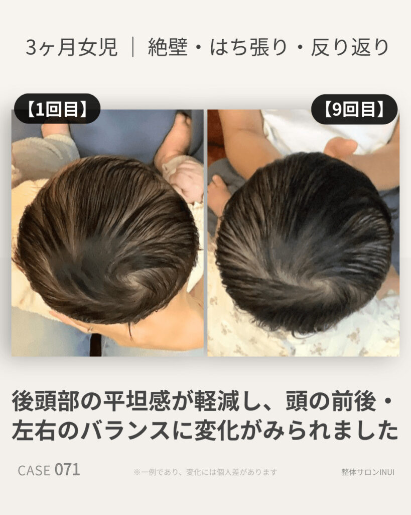 生後3ヶ月女児の絶壁頭ビフォーアフター比較