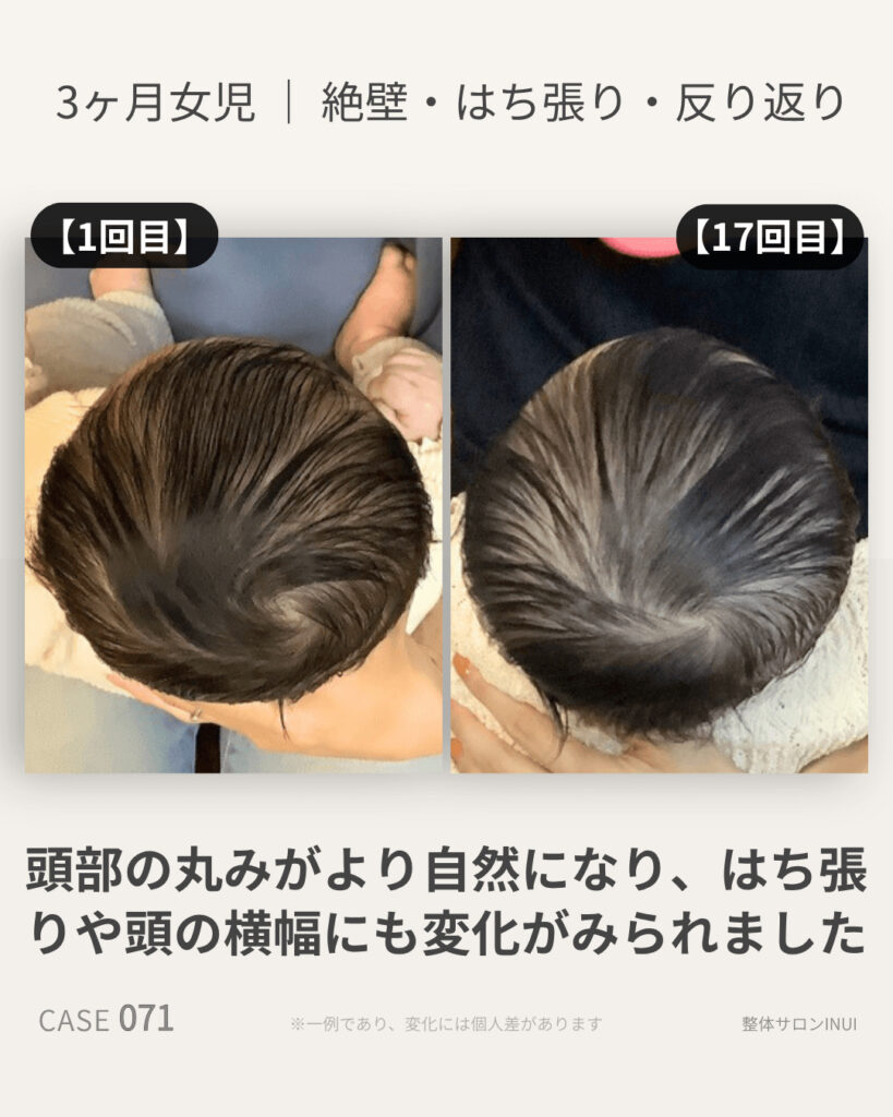 生後3ヶ月女児の絶壁頭ビフォーアフター比較