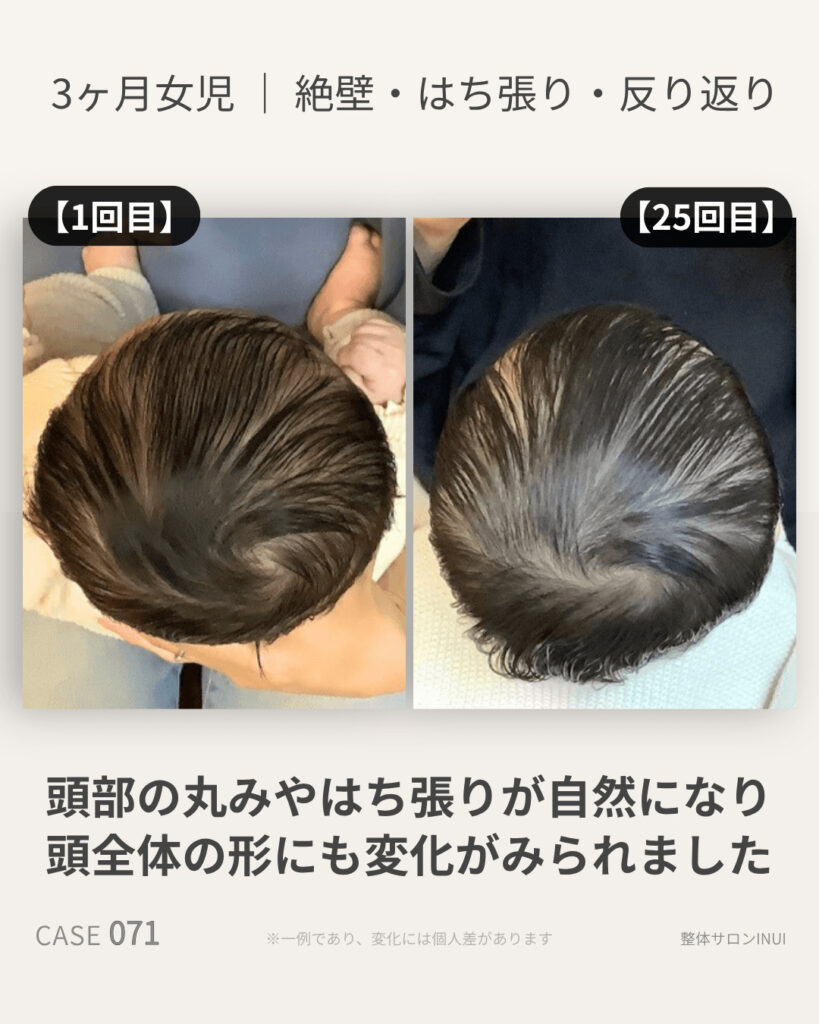 生後3ヶ月女児の絶壁頭ビフォーアフター比較