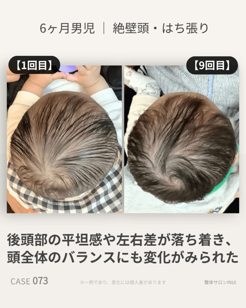 生後6ヶ月男児の絶壁頭ビフォーアフター比較