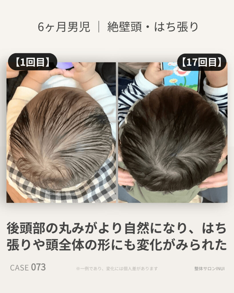 生後6ヶ月男児の絶壁頭ビフォーアフター比較