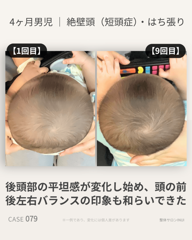 生後4ヶ月男児の絶壁頭ビフォーアフター比較
