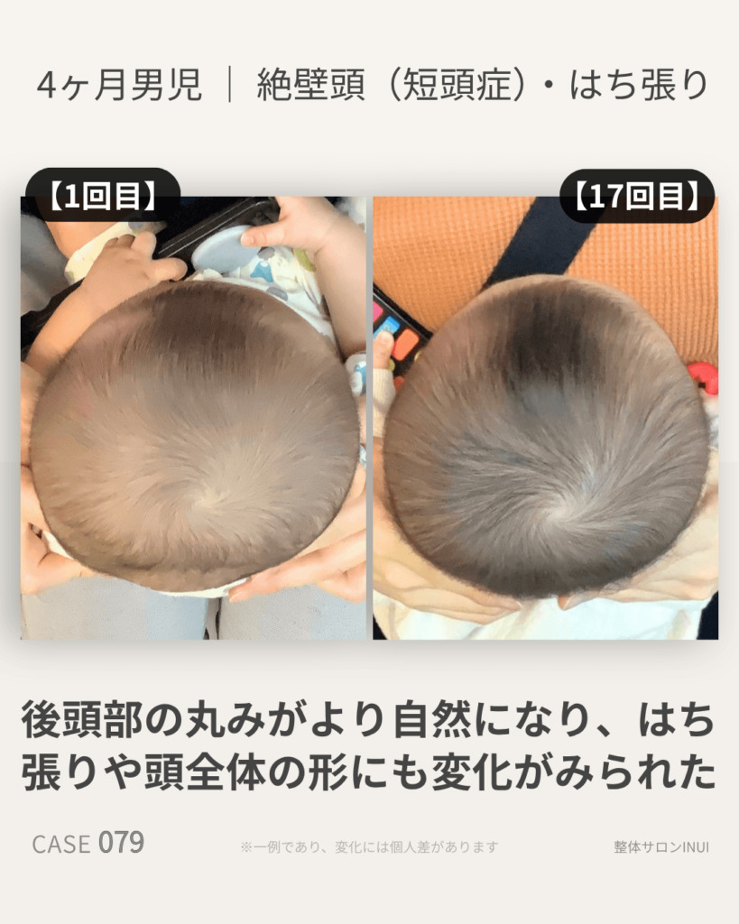 生後4ヶ月男児の絶壁頭ビフォーアフター比較