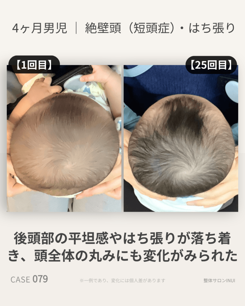 生後4ヶ月男児の絶壁頭ビフォーアフター比較