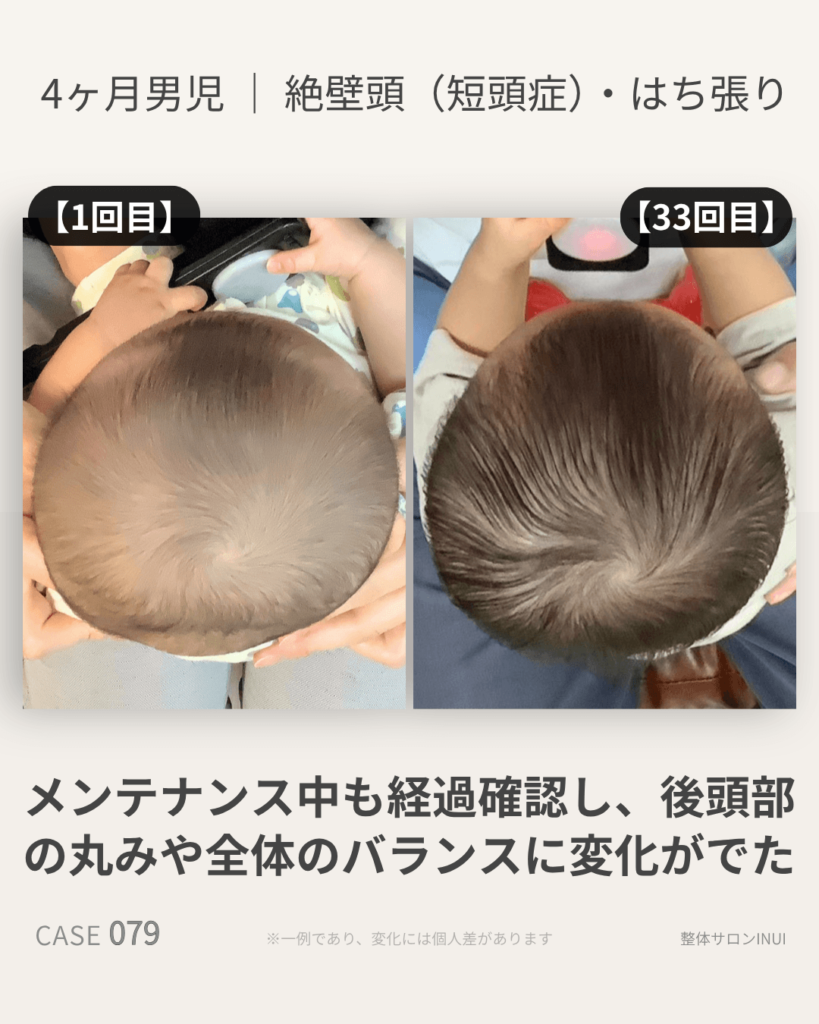 生後4ヶ月男児の絶壁頭ビフォーアフター比較