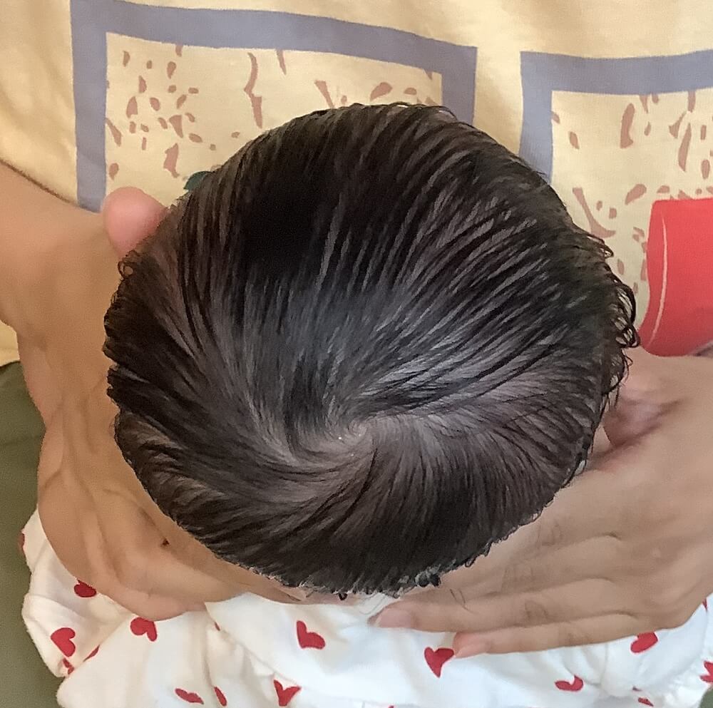 生後4ヶ月女児の絶壁頭による後頭部の平坦感