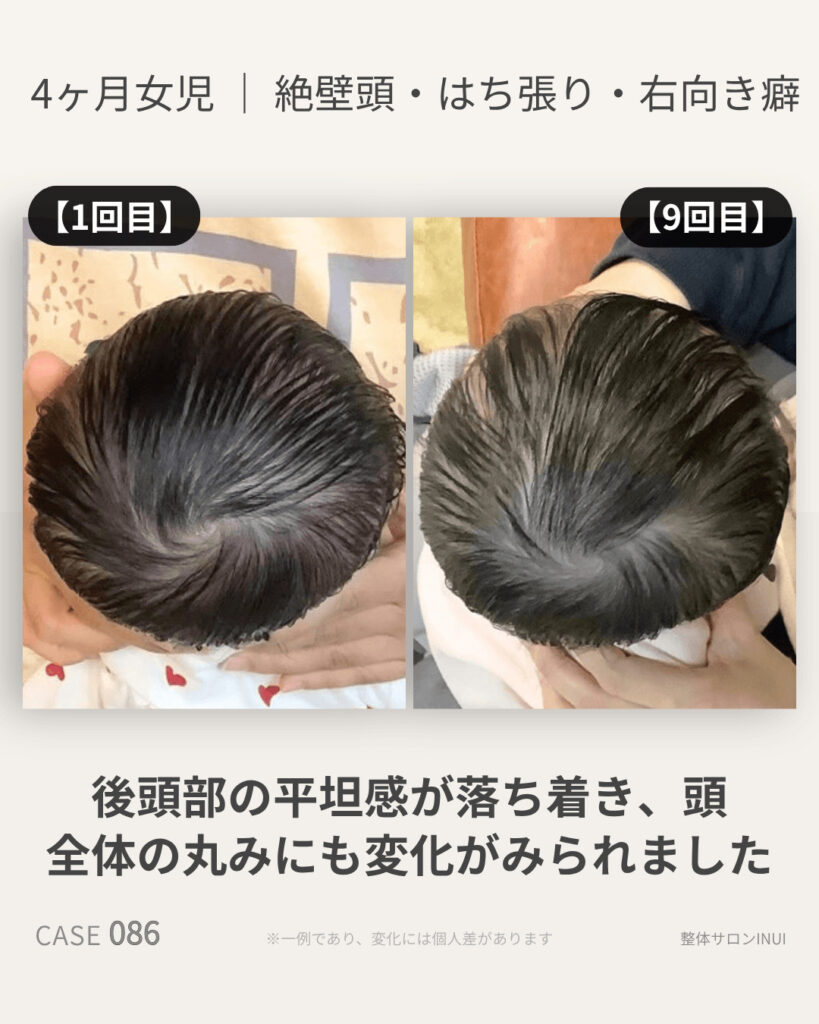生後4ヶ月女児の絶壁頭ビフォーアフター比較