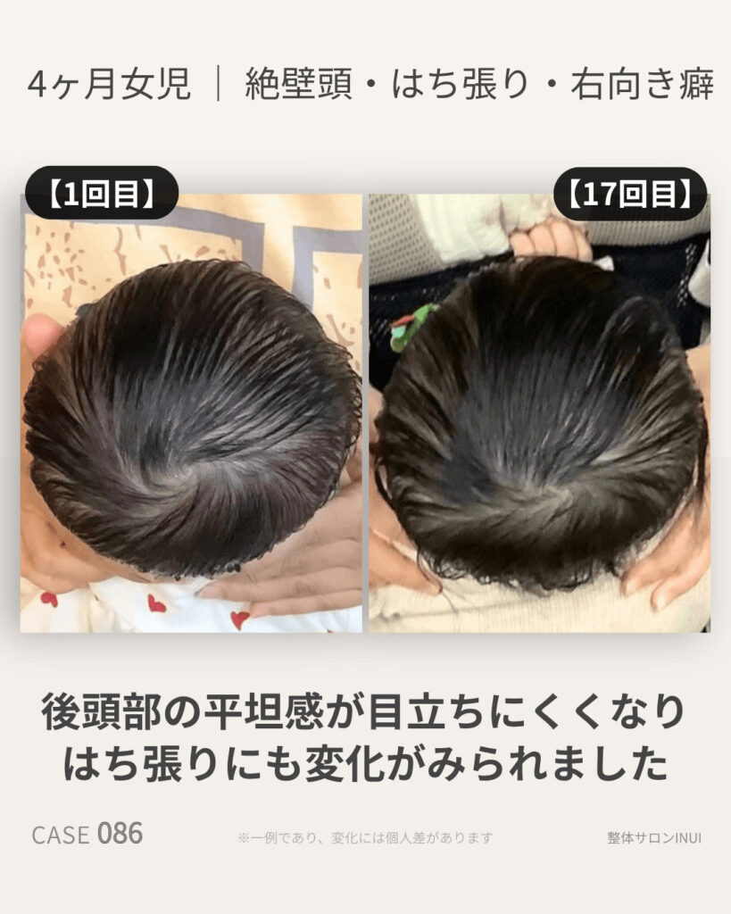 生後4ヶ月女児の絶壁頭ビフォーアフター比較