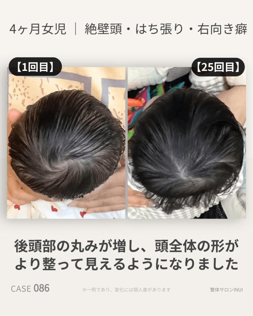 生後4ヶ月女児の絶壁頭ビフォーアフター比較