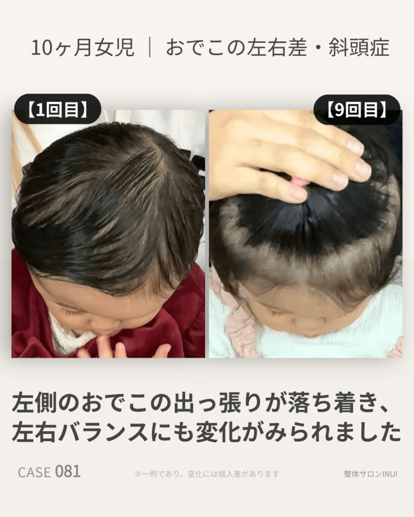 生後10ヶ月女児のおでこの左右差・斜頭症のビフォーアフター比較