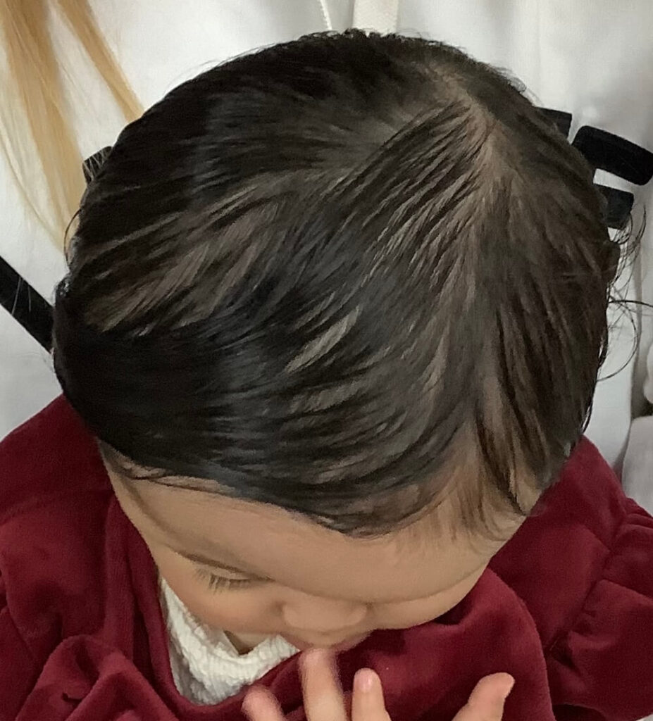 生後10ヶ月女児の斜頭症・おでこの左右差の症例写真