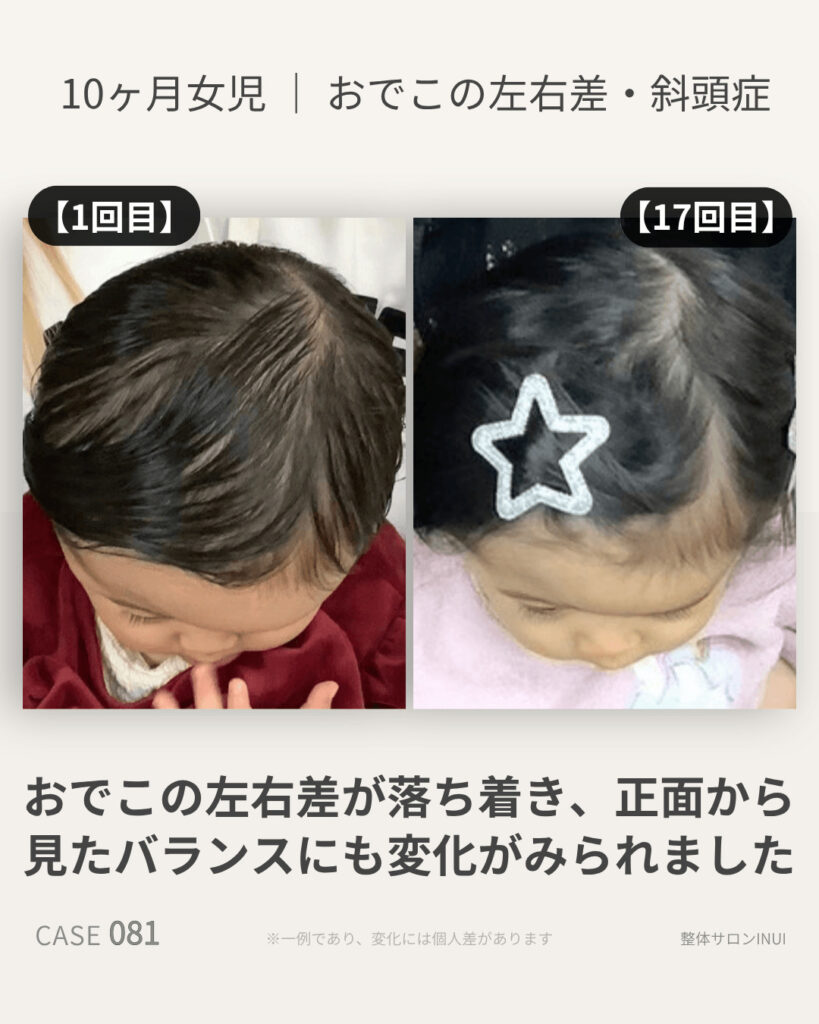 生後10ヶ月女児のおでこの左右差・斜頭症のビフォーアフター比較