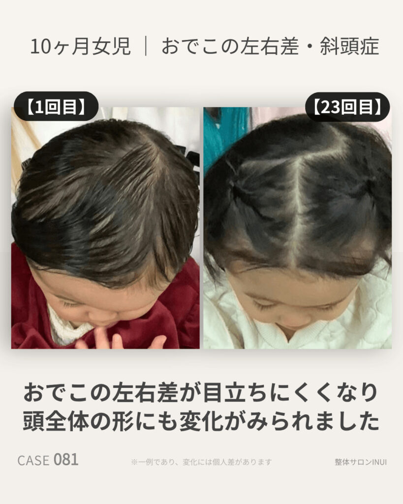 生後10ヶ月女児のおでこの左右差・斜頭症のビフォーアフター比較