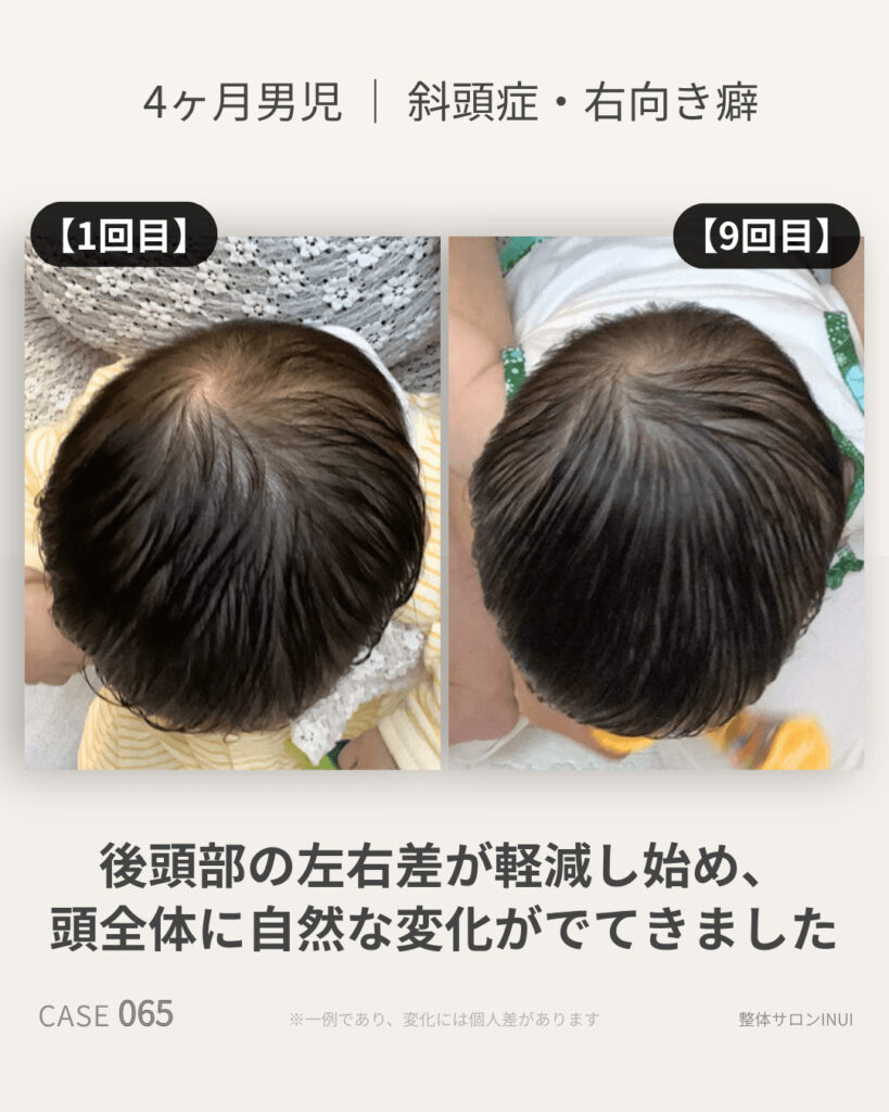生後4ヶ月男児の斜頭症ビフォーアフター比較