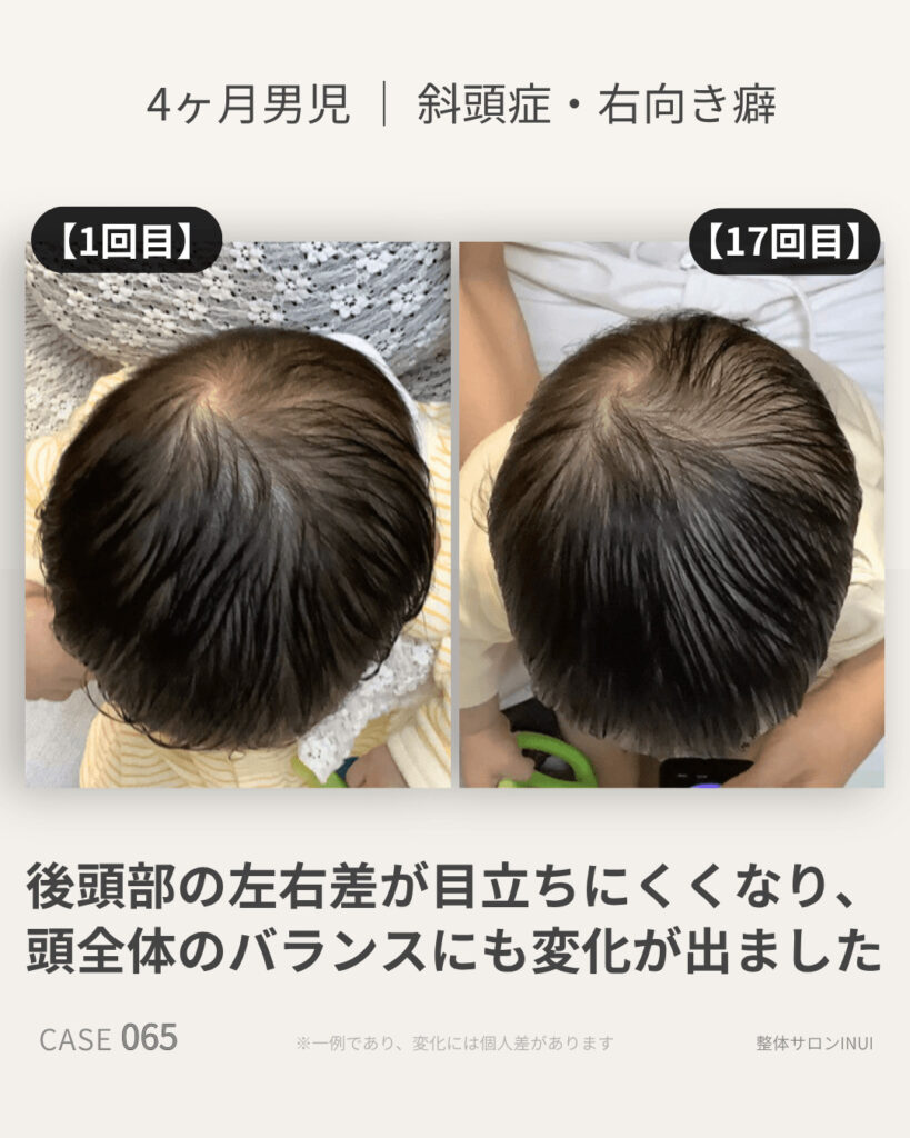 生後4ヶ月男児の斜頭症ビフォーアフター比較