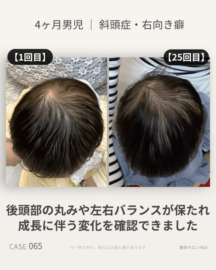 生後4ヶ月男児の斜頭症ビフォーアフター比較
