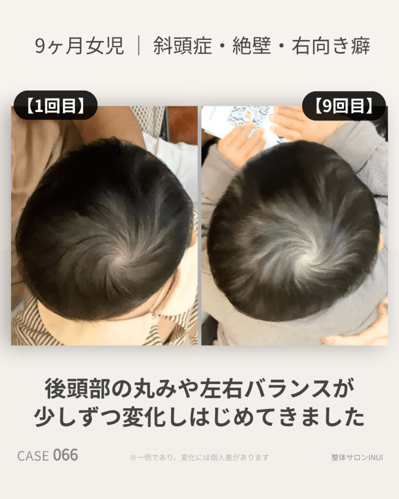 生後9ヶ月女児の斜頭症ビフォーアフター比較