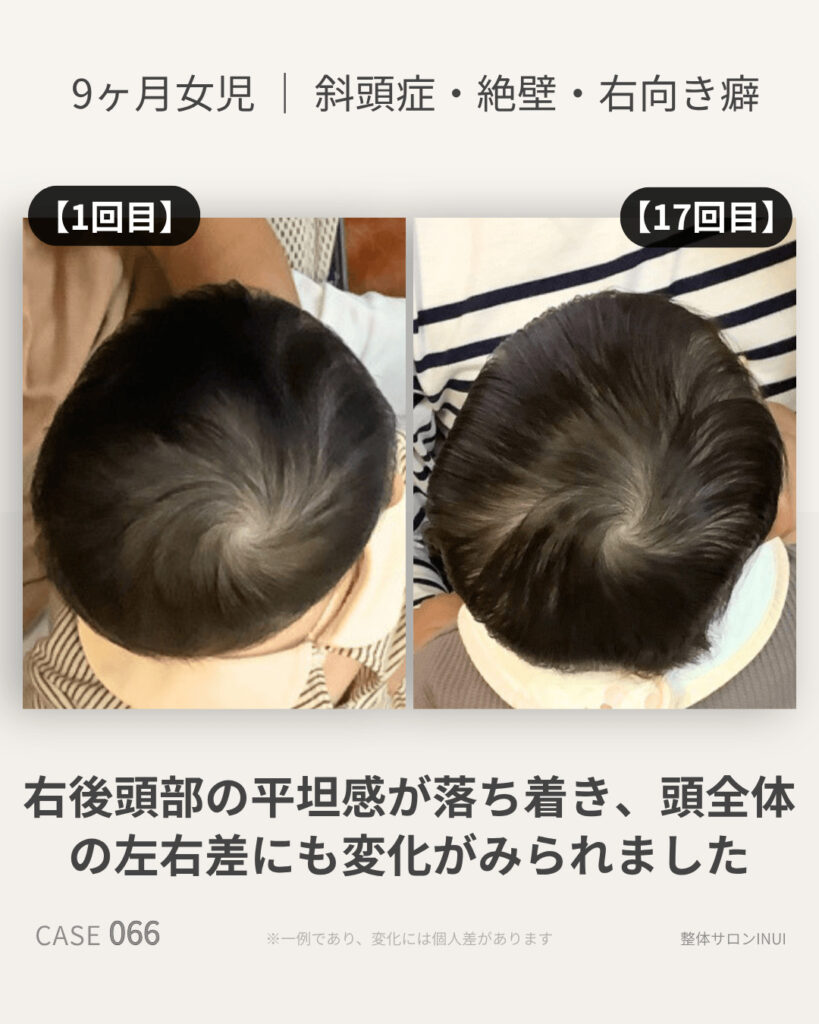 生後9ヶ月女児の斜頭症ビフォーアフター比較