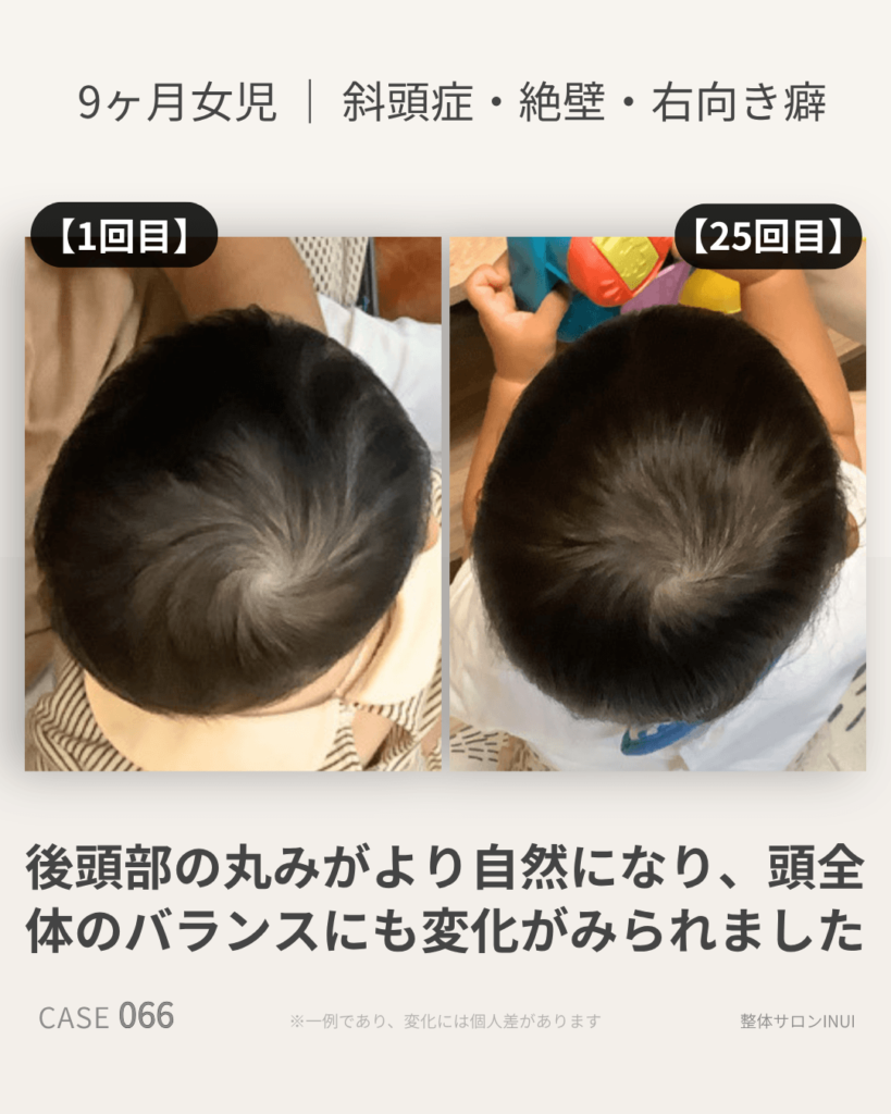 生後9ヶ月女児の斜頭症ビフォーアフター比較