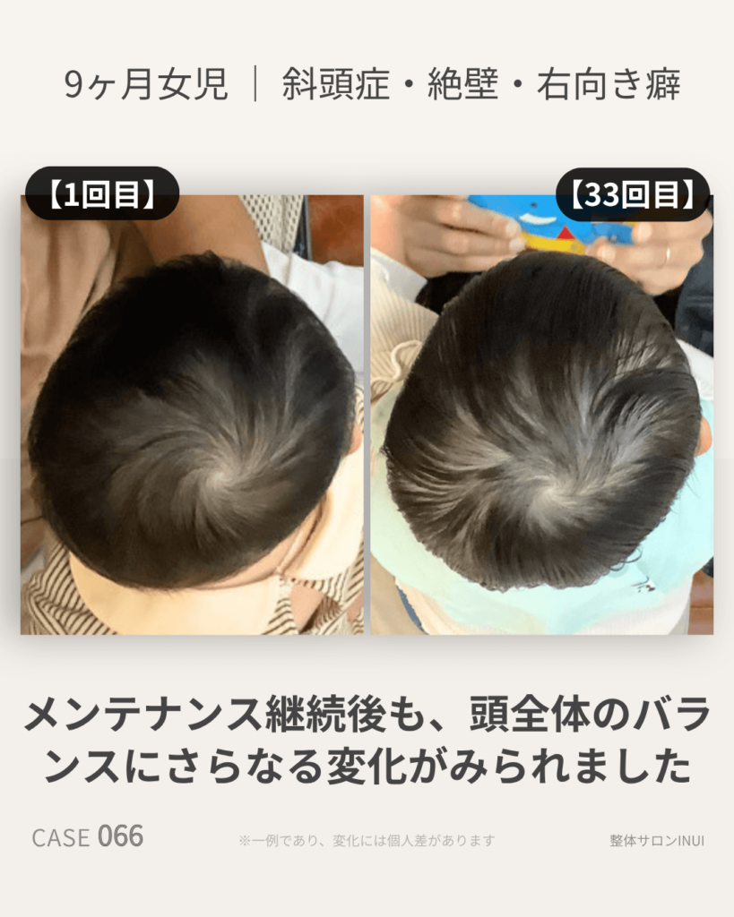 生後9ヶ月女児の斜頭症ビフォーアフター比較