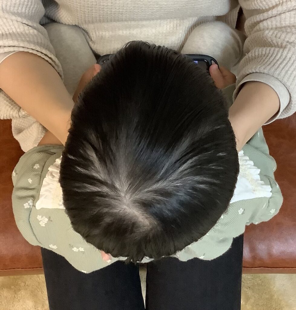 2歳2ヶ月女児の斜頭症による後頭部左右差