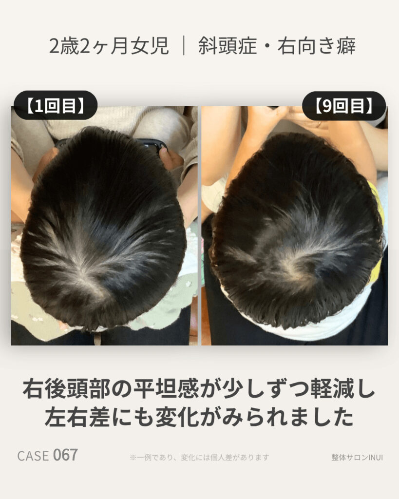 2歳2ヶ月女児の斜頭症ビフォーアフター比較