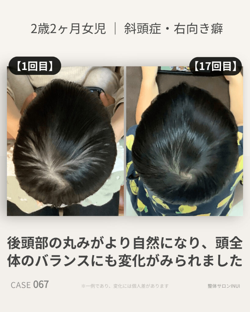 2歳2ヶ月女児の斜頭症ビフォーアフター比較