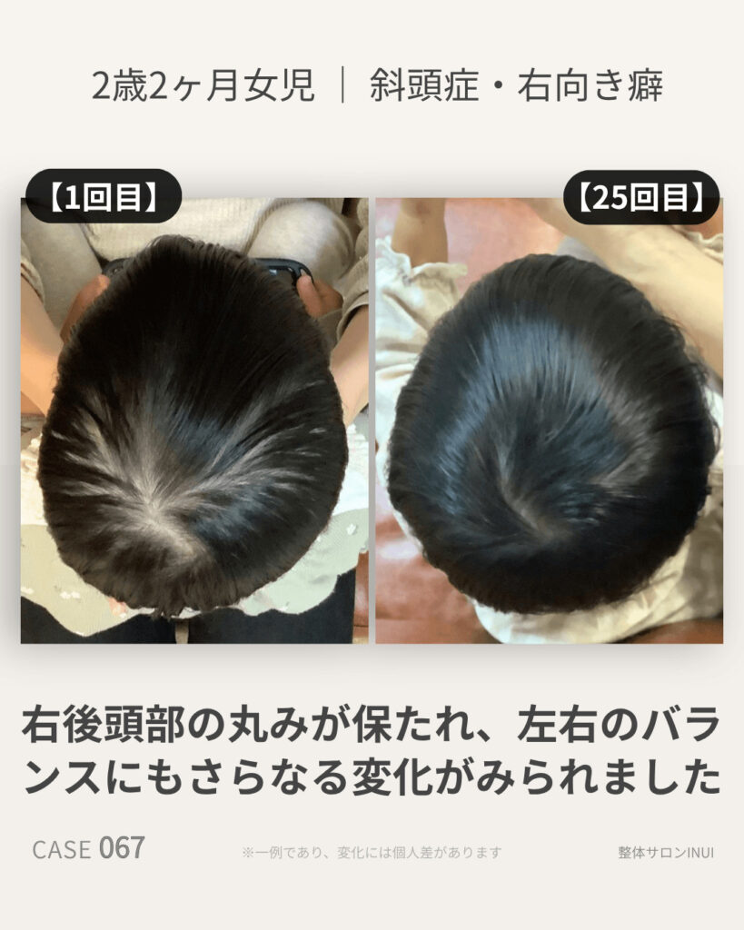 2歳2ヶ月女児の斜頭症ビフォーアフター比較