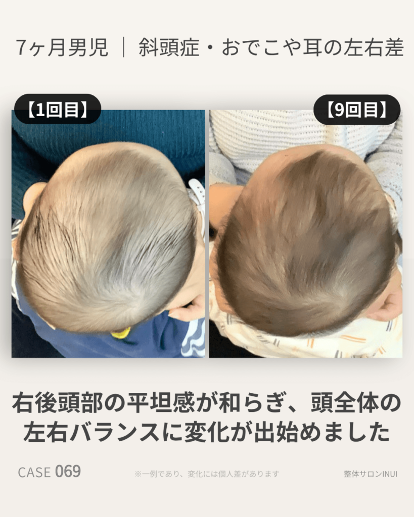 生後7ヶ月男児の斜頭症ビフォーアフター比較