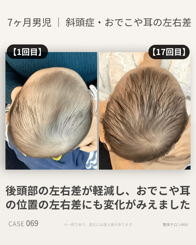 生後7ヶ月男児の斜頭症ビフォーアフター比較