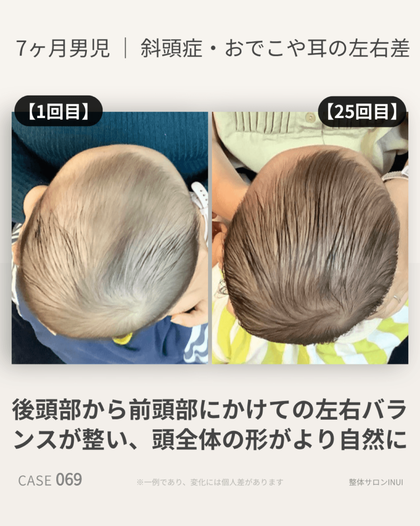 生後7ヶ月男児の斜頭症ビフォーアフター比較