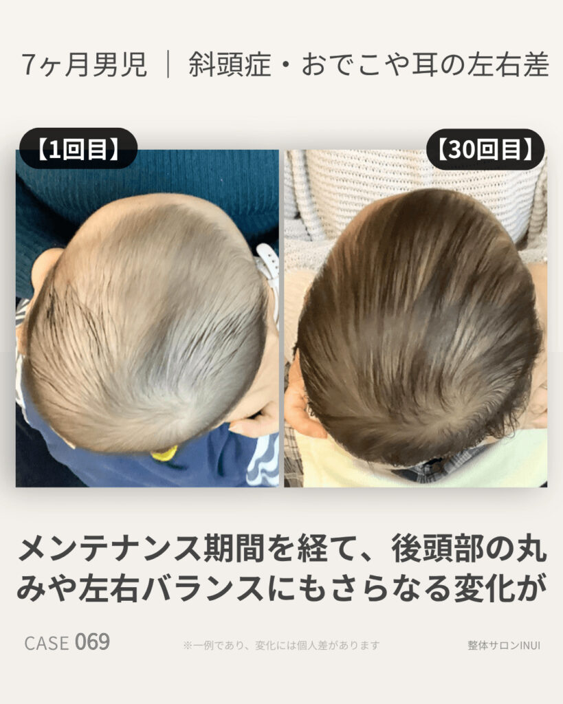 生後7ヶ月男児の斜頭症ビフォーアフター比較