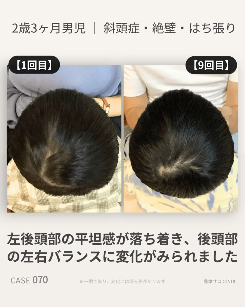 2歳3ヶ月男児の斜頭症ビフォーアフター比較