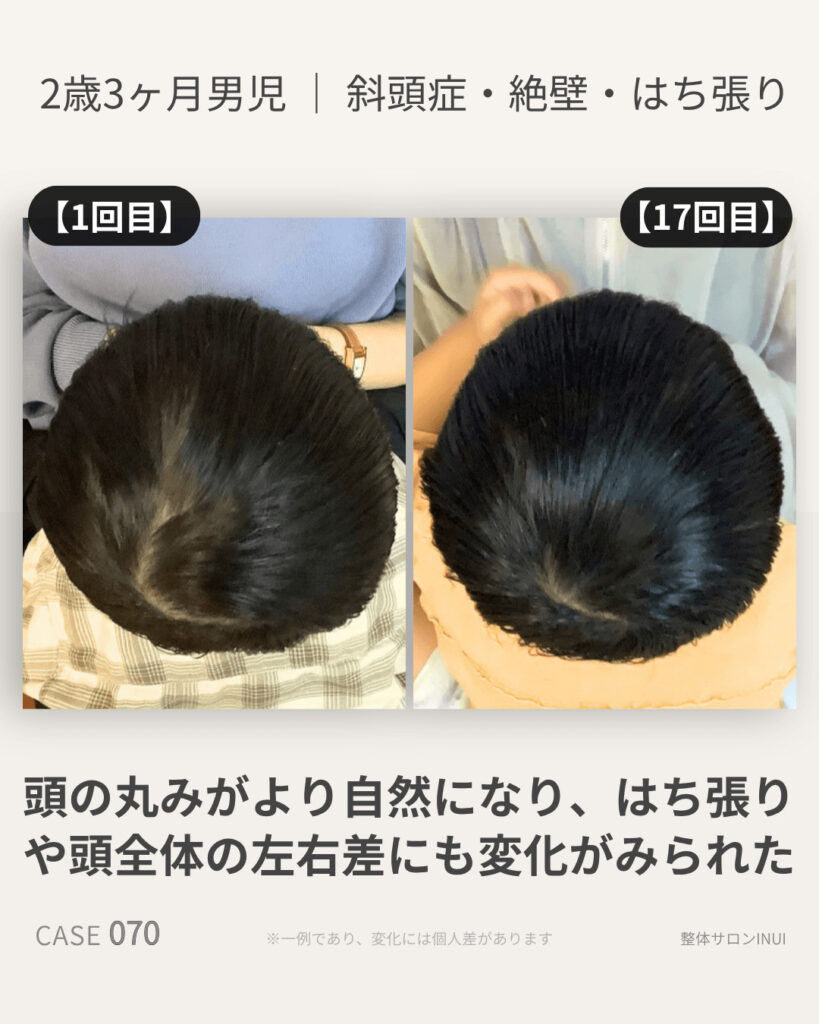 2歳3ヶ月男児の斜頭症ビフォーアフター比較