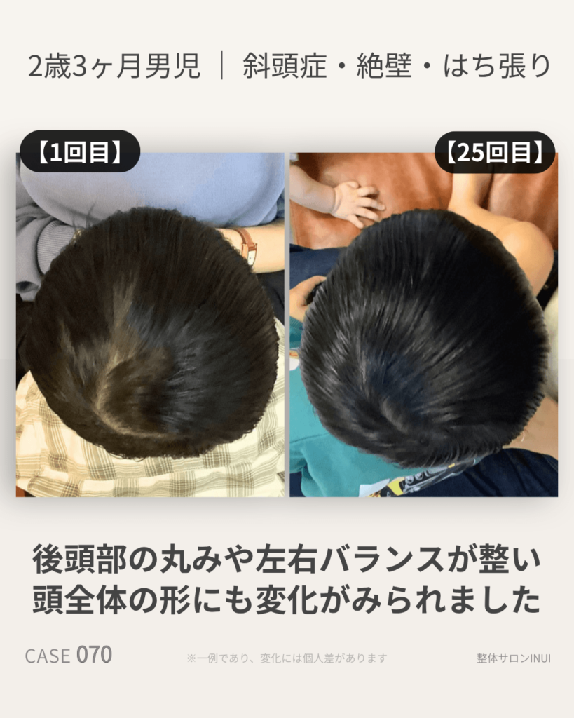 2歳3ヶ月男児の斜頭症ビフォーアフター比較