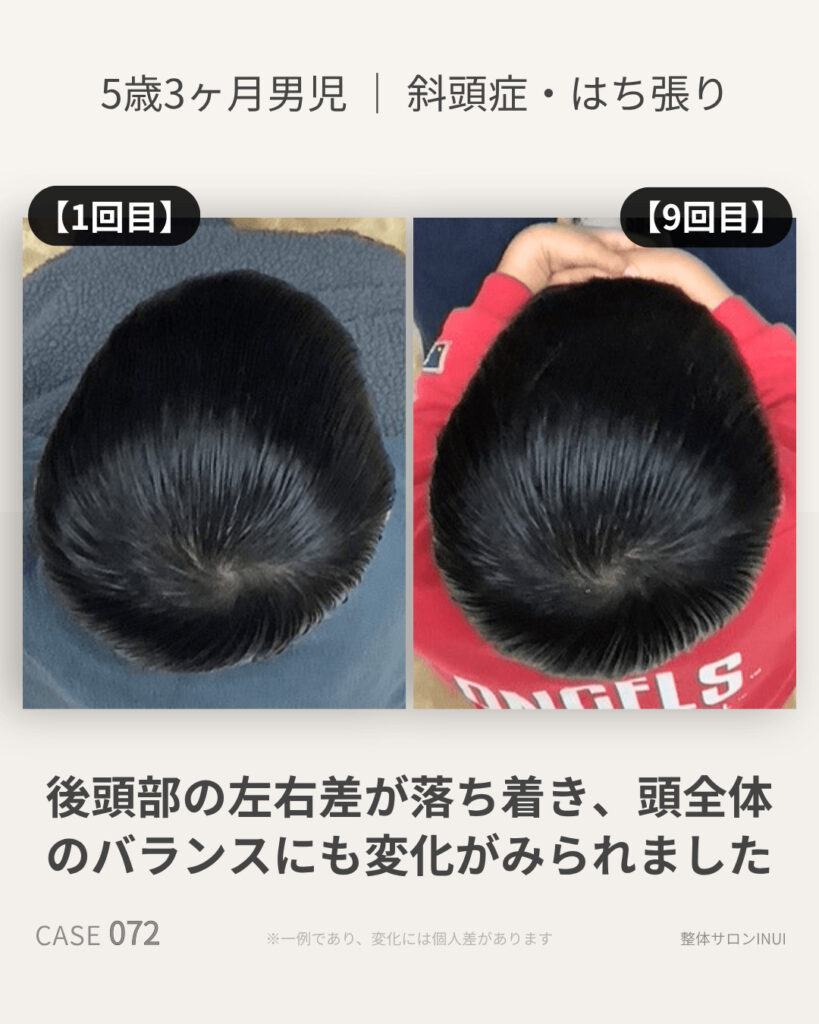 5歳3ヶ月男児の斜頭症ビフォーアフター比較