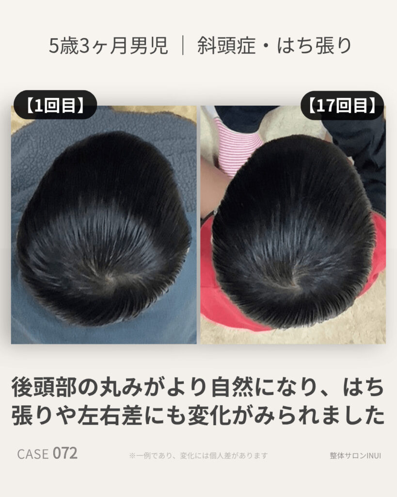 5歳3ヶ月男児の斜頭症ビフォーアフター比較
