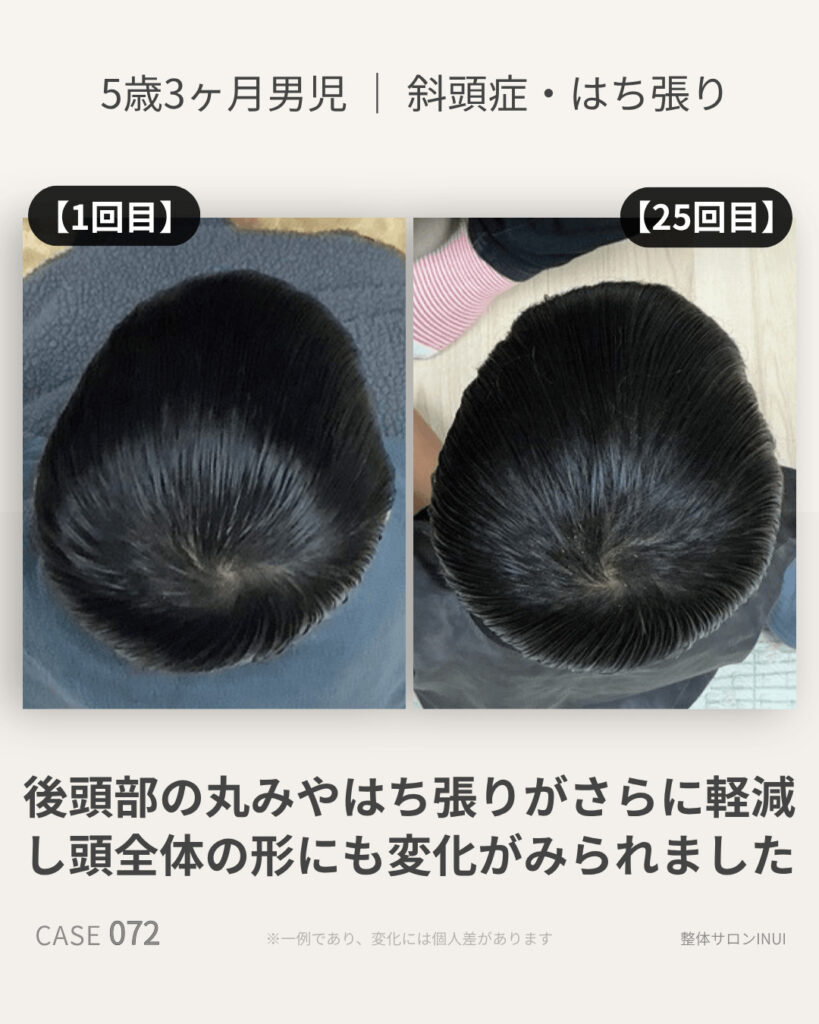 5歳3ヶ月男児の斜頭症ビフォーアフター比較