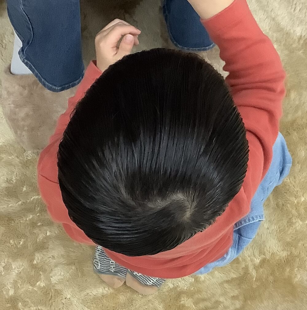 3歳4ヶ月男児の斜頭症による後頭部左右差