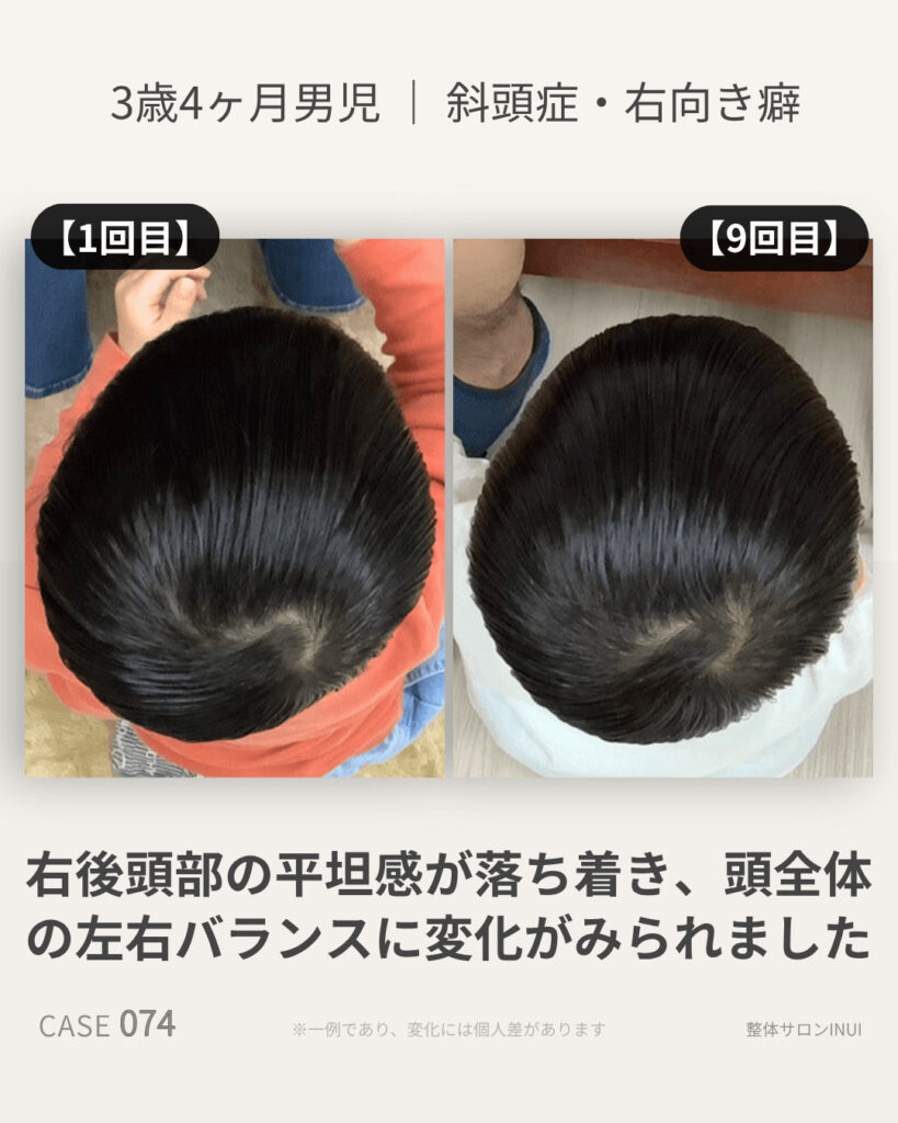 3歳4ヶ月男児の斜頭症ビフォーアフター比較