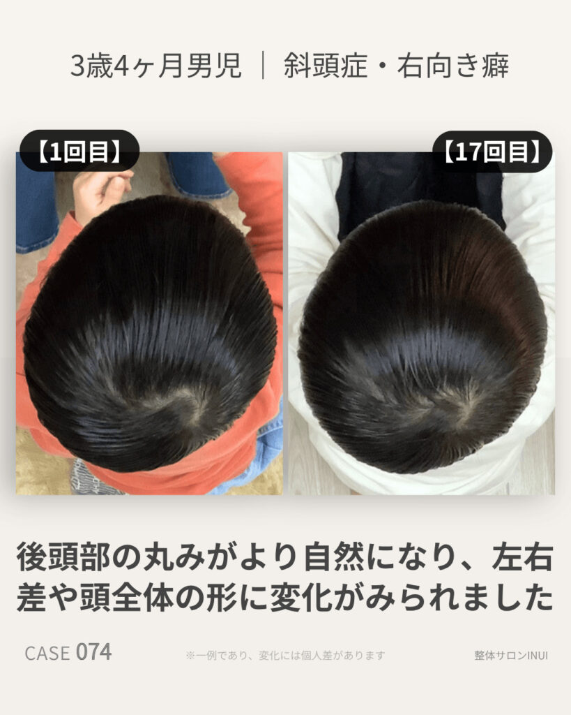 3歳4ヶ月男児の斜頭症ビフォーアフター比較