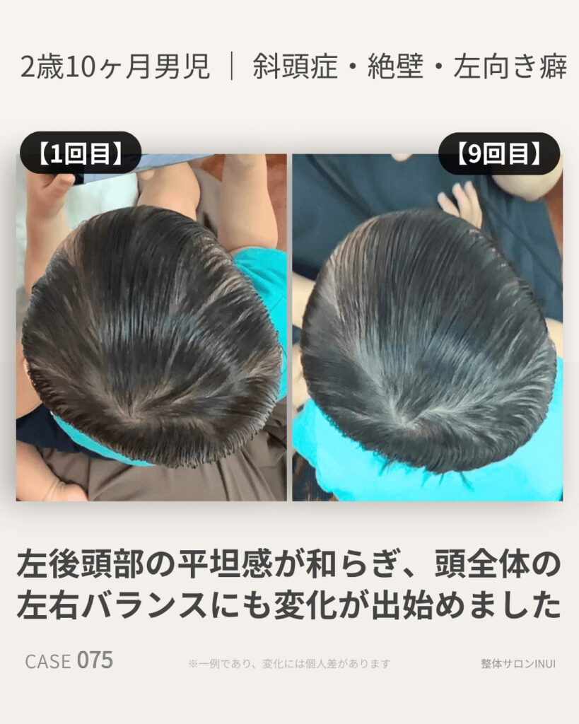 2歳10ヶ月男児の斜頭症ビフォーアフター比較