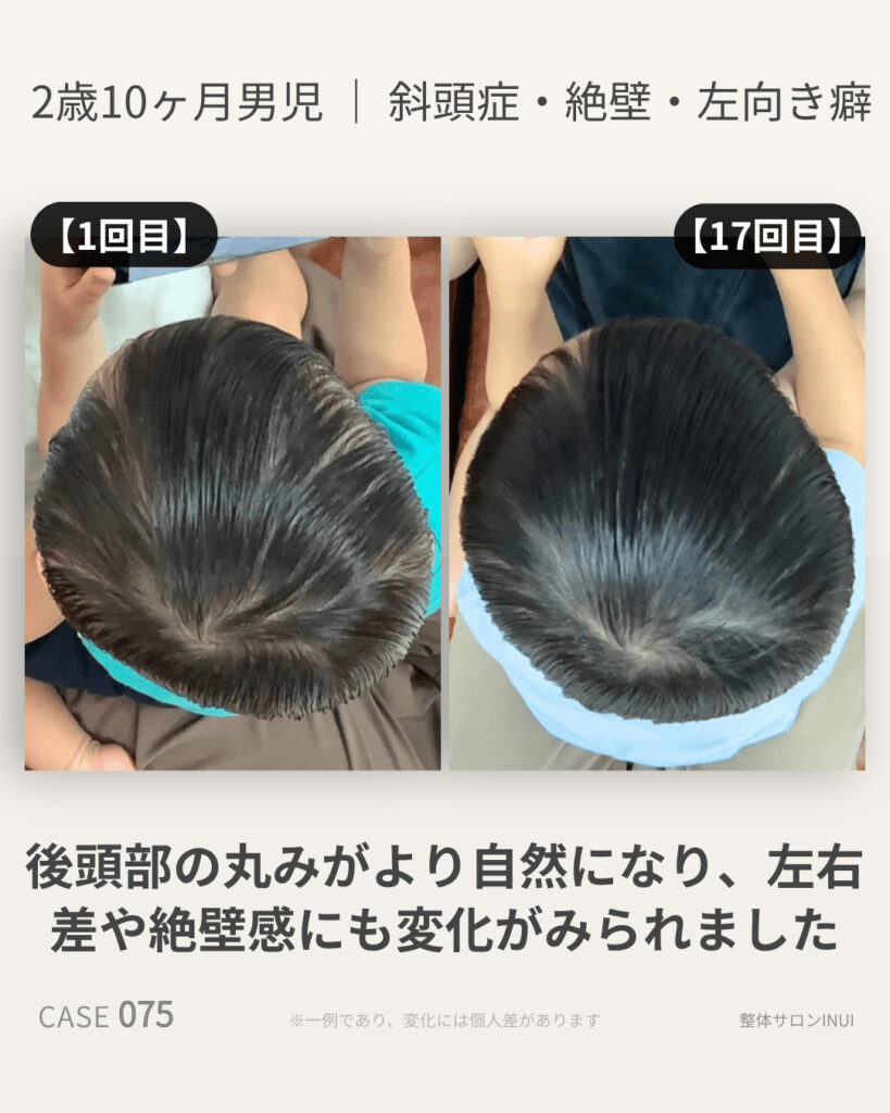 2歳10ヶ月男児の斜頭症ビフォーアフター比較