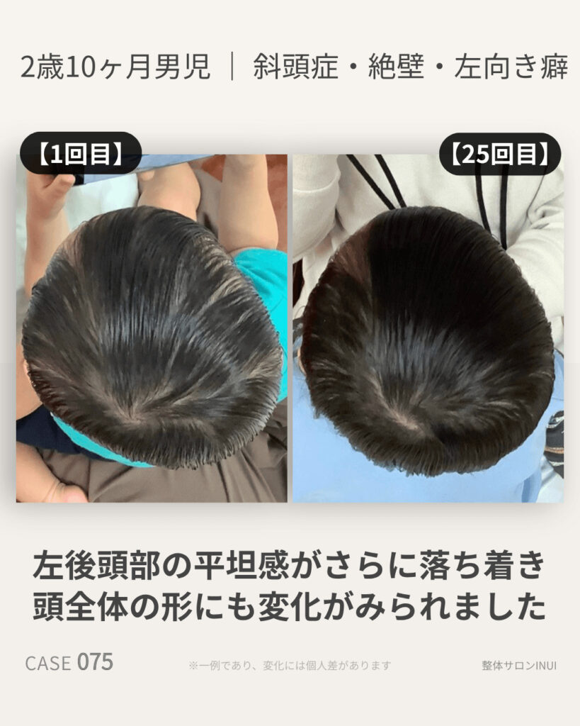 2歳10ヶ月男児の斜頭症ビフォーアフター比較