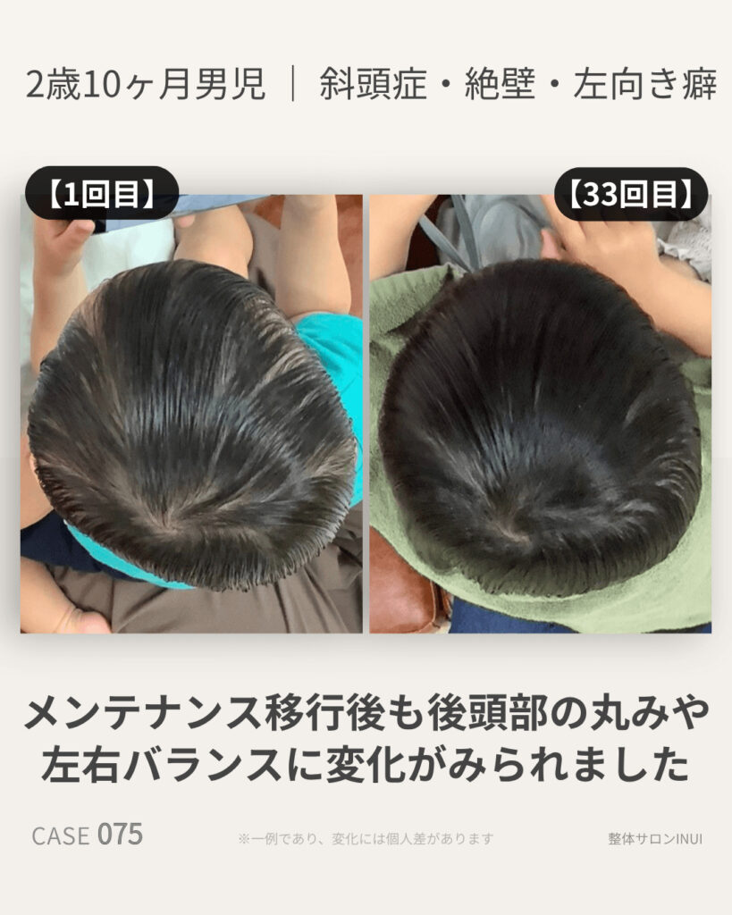 2歳10ヶ月男児の斜頭症ビフォーアフター比較