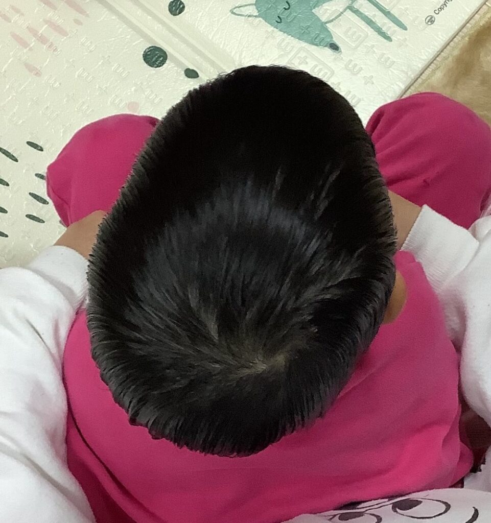 3歳8ヶ月男児の斜頭症による後頭部左右差