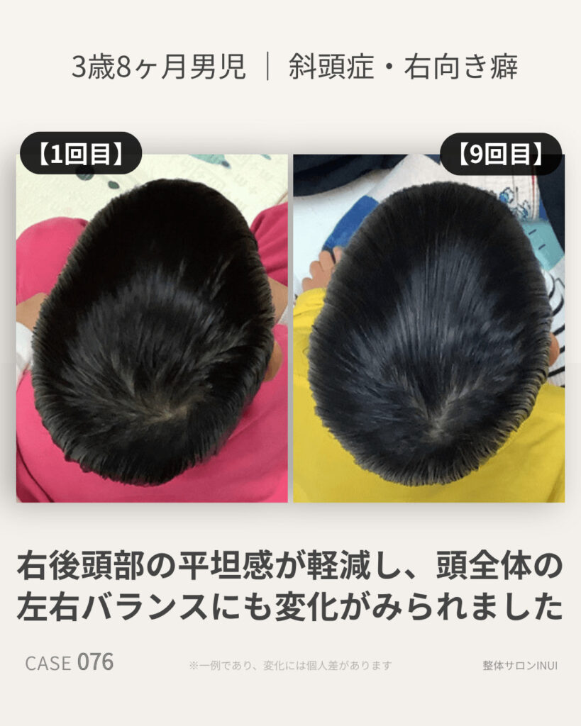 3歳8ヶ月男児の斜頭症による後頭部左右差